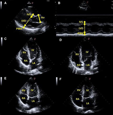 interventricular septum thickness measurement|interventricular septum thickness end diastole.